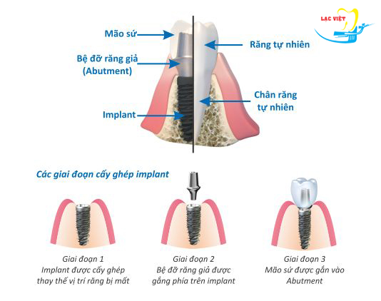 quy trình trồng răng implant tại nha khoa lạc việt