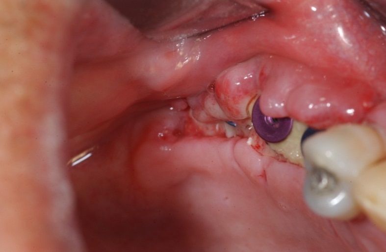 biến chứng trồng răng implant.