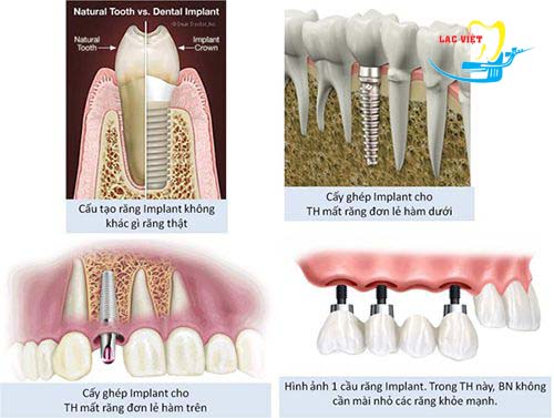 công nghệ trồng răng implant