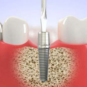 Thực hư tình trạng kích ứng sau cấy răng Implant- Có thể bạn nên đọc