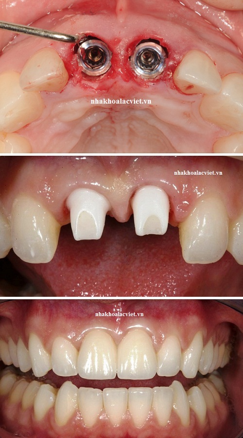Trồng implant răng cửa nên lựa chọn loại nào?