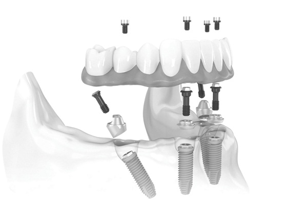 Kỹ thuật trồng răng implant all – on – 4