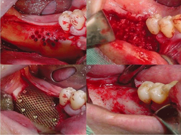Các kỹ thuật ghép xương răng trong cấy ghép implant.