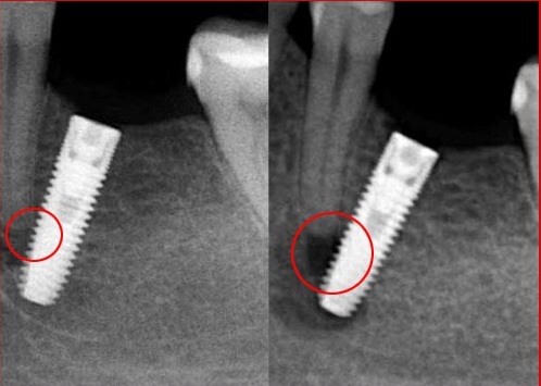 Biến chứng của trồng răng implant