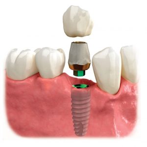 răng sứ trên implant gắn xi măng