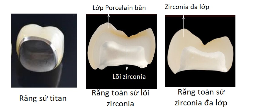các loại răng sứ trên implant