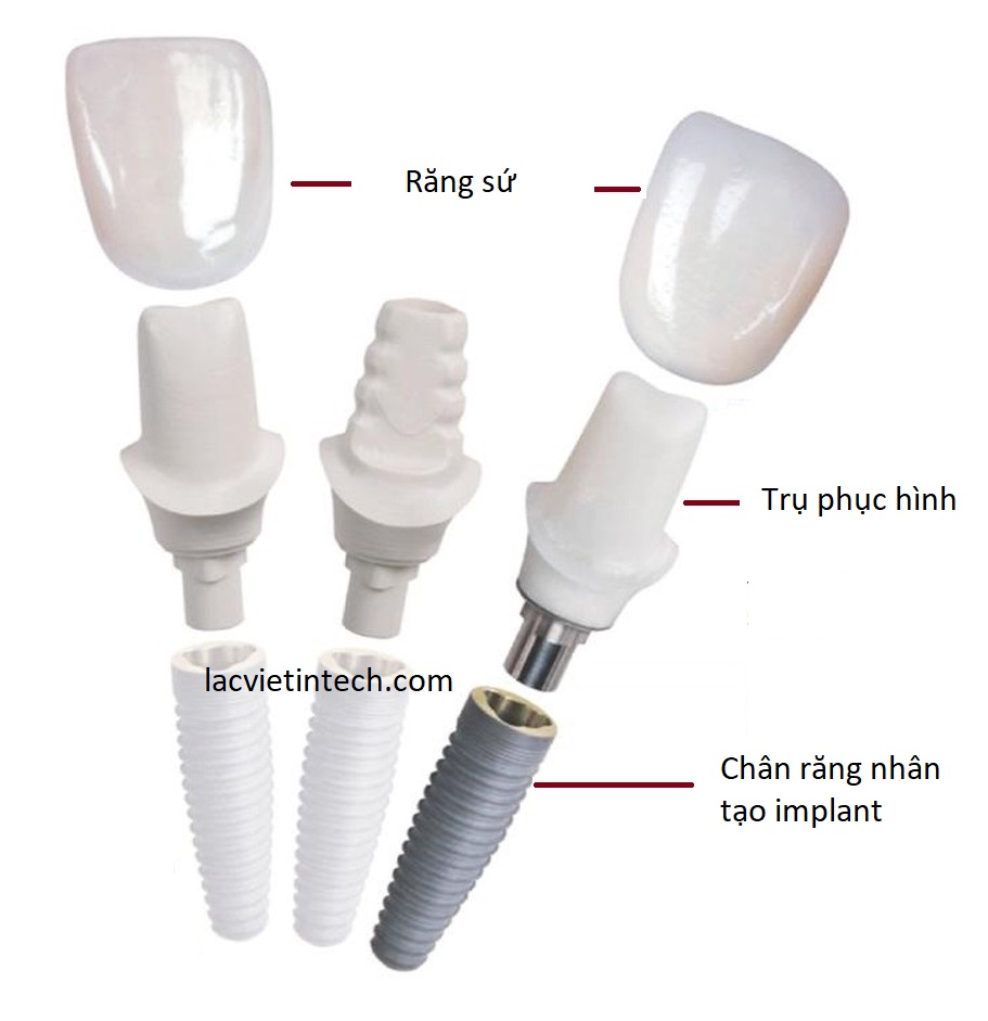trồng răng implant nha khoa Lạc Việt 