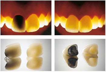 Các loại răng sứ trên implant