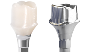 Các loại trụ phục hình trên răng implant.