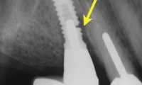 Trồng răng implant được bao lâu?