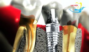Sự khác nhau giữa các loại răng implant.