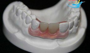 Trồng răng giả tháo lắp có thể sử dụng được trong bao lâu