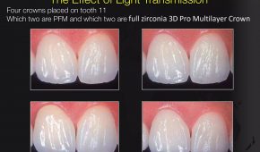 Răng sứ 3D Pro Multilayer và những điều cần biết.