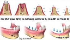 Kinh nghiệm trồng răng implant.