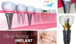 Trồng răng bằng phương pháp implant là gì?