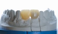 Các loại răng sứ trên implant.